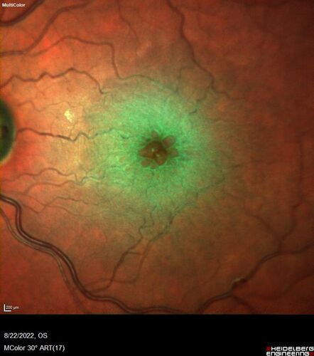 Branch Retinal Vein Occlusion and worsened cystoid macular edema following cataract surgery
51 year old female The patient noticed gradual vision loss in both eyes starting possibly after her last cataract surgery in May of 2022 (3 months ago). She had ECCE 3/2022 OD and 5/2022 OS.  She does not have diabetes. She had glaucoma shunts placed about 2017.  She has been on latanoprost and timolol.  She is now getting ready to start Combigan and Bromfenac.  She is also staring xidra for dry eye.  She stopped the latanorpost on 8/15/22.  She has had macular edema before for which she had intraocular injections which worked.  She has had no injections lately. When she was getting treated for macular edema in the past she had an IOP of 60. 
Medical Hx: Hypertension, Systemic. Glaucoma. Arthritis. Vertigo. Stroke. 
Systemic Meds: Trimfya. NAPROXEN. LISINOPRIL. 
VA OD: sc20/63-1 
VA OS: sc20/50 
IOP: TP: OD:12 OS:12
