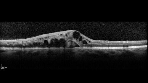 Branch Retinal Vein Occlusion and worsened cystoid macular edema following cataract surgery
51 year old female The patient noticed gradual vision loss in both eyes starting possibly after her last cataract surgery in May of 2022 (3 months ago). She had ECCE 3/2022 OD and 5/2022 OS.  She does not have diabetes. She had glaucoma shunts placed about 2017.  She has been on latanoprost and timolol.  She is now getting ready to start Combigan and Bromfenac.  She is also staring xidra for dry eye.  She stopped the latanorpost on 8/15/22.  She has had macular edema before for which she had intraocular injections which worked.  She has had no injections lately. When she was getting treated for macular edema in the past she had an IOP of 60. 
Medical Hx: Hypertension, Systemic. Glaucoma. Arthritis. Vertigo. Stroke. 
Systemic Meds: Trimfya. NAPROXEN. LISINOPRIL. 
VA OD: sc20/63-1 
VA OS: sc20/50 
IOP: TP: OD:12 OS:12
