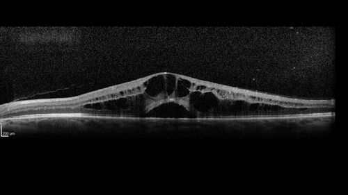 Branch Retinal Vein Occlusion and worsened cystoid macular edema following cataract surgery
51 year old female The patient noticed gradual vision loss in both eyes starting possibly after her last cataract surgery in May of 2022 (3 months ago). She had ECCE 3/2022 OD and 5/2022 OS.  She does not have diabetes. She had glaucoma shunts placed about 2017.  She has been on latanoprost and timolol.  She is now getting ready to start Combigan and Bromfenac.  She is also staring xidra for dry eye.  She stopped the latanorpost on 8/15/22.  She has had macular edema before for which she had intraocular injections which worked.  She has had no injections lately. When she was getting treated for macular edema in the past she had an IOP of 60. 
Medical Hx: Hypertension, Systemic. Glaucoma. Arthritis. Vertigo. Stroke. 
Systemic Meds: Trimfya. NAPROXEN. LISINOPRIL. 
VA OD: sc20/63-1 
VA OS: sc20/50 
IOP: TP: OD:12 OS:12
