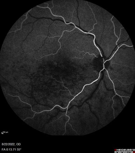 Branch Retinal Vein Occlusion and worsened cystoid macular edema following cataract surgery
51 year old female The patient noticed gradual vision loss in both eyes starting possibly after her last cataract surgery in May of 2022 (3 months ago). She had ECCE 3/2022 OD and 5/2022 OS.  She does not have diabetes. She had glaucoma shunts placed about 2017.  She has been on latanoprost and timolol.  She is now getting ready to start Combigan and Bromfenac.  She is also staring xidra for dry eye.  She stopped the latanorpost on 8/15/22.  She has had macular edema before for which she had intraocular injections which worked.  She has had no injections lately. When she was getting treated for macular edema in the past she had an IOP of 60. 
Medical Hx: Hypertension, Systemic. Glaucoma. Arthritis. Vertigo. Stroke. 
Systemic Meds: Trimfya. NAPROXEN. LISINOPRIL. 
VA OD: sc20/63-1 
VA OS: sc20/50 
IOP: TP: OD:12 OS:12

