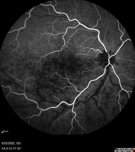 Branch Retinal Vein Occlusion and worsened cystoid macular edema following cataract surgery
51 year old female The patient noticed gradual vision loss in both eyes starting possibly after her last cataract surgery in May of 2022 (3 months ago). She had ECCE 3/2022 OD and 5/2022 OS.  She does not have diabetes. She had glaucoma shunts placed about 2017.  She has been on latanoprost and timolol.  She is now getting ready to start Combigan and Bromfenac.  She is also staring xidra for dry eye.  She stopped the latanorpost on 8/15/22.  She has had macular edema before for which she had intraocular injections which worked.  She has had no injections lately. When she was getting treated for macular edema in the past she had an IOP of 60. 
Medical Hx: Hypertension, Systemic. Glaucoma. Arthritis. Vertigo. Stroke. 
Systemic Meds: Trimfya. NAPROXEN. LISINOPRIL. 
VA OD: sc20/63-1 
VA OS: sc20/50 
IOP: TP: OD:12 OS:12

