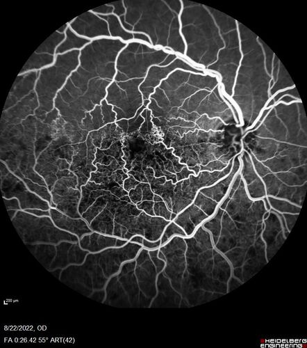 Branch Retinal Vein Occlusion and worsened cystoid macular edema following cataract surgery
51 year old female The patient noticed gradual vision loss in both eyes starting possibly after her last cataract surgery in May of 2022 (3 months ago). She had ECCE 3/2022 OD and 5/2022 OS.  She does not have diabetes. She had glaucoma shunts placed about 2017.  She has been on latanoprost and timolol.  She is now getting ready to start Combigan and Bromfenac.  She is also staring xidra for dry eye.  She stopped the latanorpost on 8/15/22.  She has had macular edema before for which she had intraocular injections which worked.  She has had no injections lately. When she was getting treated for macular edema in the past she had an IOP of 60. 
Medical Hx: Hypertension, Systemic. Glaucoma. Arthritis. Vertigo. Stroke. 
Systemic Meds: Trimfya. NAPROXEN. LISINOPRIL. 
VA OD: sc20/63-1 
VA OS: sc20/50 
IOP: TP: OD:12 OS:12

