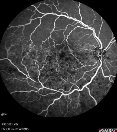 Branch Retinal Vein Occlusion and worsened cystoid macular edema following cataract surgery
51 year old female The patient noticed gradual vision loss in both eyes starting possibly after her last cataract surgery in May of 2022 (3 months ago). She had ECCE 3/2022 OD and 5/2022 OS.  She does not have diabetes. She had glaucoma shunts placed about 2017.  She has been on latanoprost and timolol.  She is now getting ready to start Combigan and Bromfenac.  She is also staring xidra for dry eye.  She stopped the latanorpost on 8/15/22.  She has had macular edema before for which she had intraocular injections which worked.  She has had no injections lately. When she was getting treated for macular edema in the past she had an IOP of 60. 
Medical Hx: Hypertension, Systemic. Glaucoma. Arthritis. Vertigo. Stroke. 
Systemic Meds: Trimfya. NAPROXEN. LISINOPRIL. 
VA OD: sc20/63-1 
VA OS: sc20/50 
IOP: TP: OD:12 OS:12
