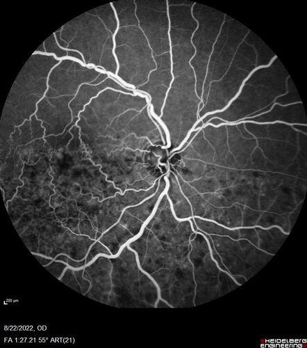 Branch Retinal Vein Occlusion and worsened cystoid macular edema following cataract surgery
51 year old female The patient noticed gradual vision loss in both eyes starting possibly after her last cataract surgery in May of 2022 (3 months ago). She had ECCE 3/2022 OD and 5/2022 OS.  She does not have diabetes. She had glaucoma shunts placed about 2017.  She has been on latanoprost and timolol.  She is now getting ready to start Combigan and Bromfenac.  She is also staring xidra for dry eye.  She stopped the latanorpost on 8/15/22.  She has had macular edema before for which she had intraocular injections which worked.  She has had no injections lately. When she was getting treated for macular edema in the past she had an IOP of 60. 
Medical Hx: Hypertension, Systemic. Glaucoma. Arthritis. Vertigo. Stroke. 
Systemic Meds: Trimfya. NAPROXEN. LISINOPRIL. 
VA OD: sc20/63-1 
VA OS: sc20/50 
IOP: TP: OD:12 OS:12
