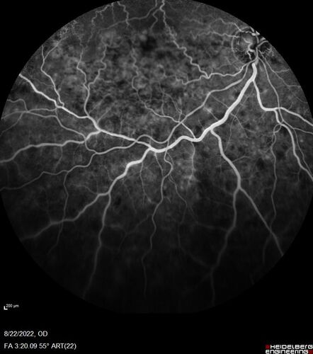 Branch Retinal Vein Occlusion and worsened cystoid macular edema following cataract surgery
51 year old female The patient noticed gradual vision loss in both eyes starting possibly after her last cataract surgery in May of 2022 (3 months ago). She had ECCE 3/2022 OD and 5/2022 OS.  She does not have diabetes. She had glaucoma shunts placed about 2017.  She has been on latanoprost and timolol.  She is now getting ready to start Combigan and Bromfenac.  She is also staring xidra for dry eye.  She stopped the latanorpost on 8/15/22.  She has had macular edema before for which she had intraocular injections which worked.  She has had no injections lately. When she was getting treated for macular edema in the past she had an IOP of 60. 
Medical Hx: Hypertension, Systemic. Glaucoma. Arthritis. Vertigo. Stroke. 
Systemic Meds: Trimfya. NAPROXEN. LISINOPRIL. 
VA OD: sc20/63-1 
VA OS: sc20/50 
IOP: TP: OD:12 OS:12
