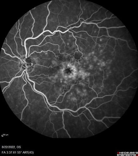 Branch Retinal Vein Occlusion and worsened cystoid macular edema following cataract surgery
51 year old female The patient noticed gradual vision loss in both eyes starting possibly after her last cataract surgery in May of 2022 (3 months ago). She had ECCE 3/2022 OD and 5/2022 OS.  She does not have diabetes. She had glaucoma shunts placed about 2017.  She has been on latanoprost and timolol.  She is now getting ready to start Combigan and Bromfenac.  She is also staring xidra for dry eye.  She stopped the latanorpost on 8/15/22.  She has had macular edema before for which she had intraocular injections which worked.  She has had no injections lately. When she was getting treated for macular edema in the past she had an IOP of 60. 
Medical Hx: Hypertension, Systemic. Glaucoma. Arthritis. Vertigo. Stroke. 
Systemic Meds: Trimfya. NAPROXEN. LISINOPRIL. 
VA OD: sc20/63-1 
VA OS: sc20/50 
IOP: TP: OD:12 OS:12
