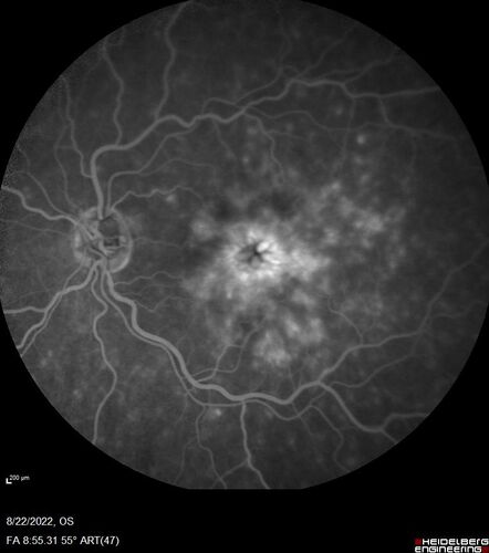 Branch Retinal Vein Occlusion and worsened cystoid macular edema following cataract surgery
51 year old female The patient noticed gradual vision loss in both eyes starting possibly after her last cataract surgery in May of 2022 (3 months ago). She had ECCE 3/2022 OD and 5/2022 OS.  She does not have diabetes. She had glaucoma shunts placed about 2017.  She has been on latanoprost and timolol.  She is now getting ready to start Combigan and Bromfenac.  She is also staring xidra for dry eye.  She stopped the latanorpost on 8/15/22.  She has had macular edema before for which she had intraocular injections which worked.  She has had no injections lately. When she was getting treated for macular edema in the past she had an IOP of 60. 
Medical Hx: Hypertension, Systemic. Glaucoma. Arthritis. Vertigo. Stroke. 
Systemic Meds: Trimfya. NAPROXEN. LISINOPRIL. 
VA OD: sc20/63-1 
VA OS: sc20/50 
IOP: TP: OD:12 OS:12
