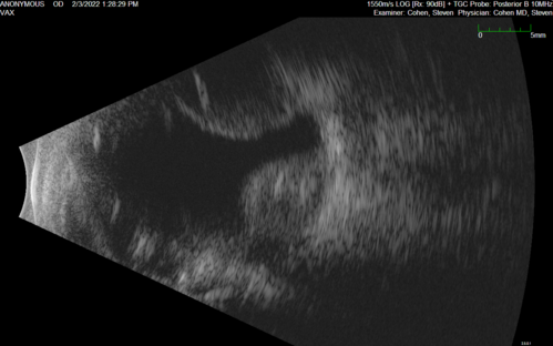 Choroidal Hemorrhage following intraocular lens exchange surgery
68 year old man Patient is 1 week post IOL exchange with sutured Akreos PCIOL with PST Kenalog.  IOP was 12 on POD 1 and 21 today (POD 7).  Preop the IOP was 17.  
He has a history of retinal detachment repair 12 years ago with PPV, Buckle, Laser and Gas.

VA OD: 20/200, OS: 20/50.  IOP 21, 19
