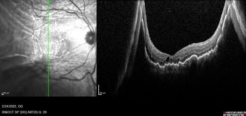 Choroidal Hemorrhage following intraocular lens exchange surgery
68 year old man Patient is 1 week post IOL exchange with sutured Akreos PCIOL with PST Kenalog.  IOP was 12 on POD 1 and 21 today (POD 7).  Preop the IOP was 17.  
He has a history of retinal detachment repair 12 years ago with PPV, Buckle, Laser and Gas.

VA OD: 20/200, OS: 20/50.  IOP 21, 19
