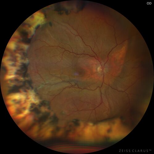 Choroidal Hemorrhage following intraocular lens exchange surgery
68 year old man Patient is 1 week post IOL exchange with sutured Akreos PCIOL with PST Kenalog.  IOP was 12 on POD 1 and 21 today (POD 7).  Preop the IOP was 17.  
He has a history of retinal detachment repair 12 years ago with PPV, Buckle, Laser and Gas.

VA OD: 20/200, OS: 20/50.  IOP 21, 19
