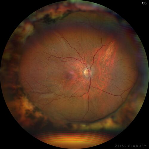 Choroidal Hemorrhage following intraocular lens exchange surgery
68 year old man Patient is 1 week post IOL exchange with sutured Akreos PCIOL with PST Kenalog.  IOP was 12 on POD 1 and 21 today (POD 7).  Preop the IOP was 17.  
He has a history of retinal detachment repair 12 years ago with PPV, Buckle, Laser and Gas.

VA OD: 20/200, OS: 20/50.  IOP 21, 19
