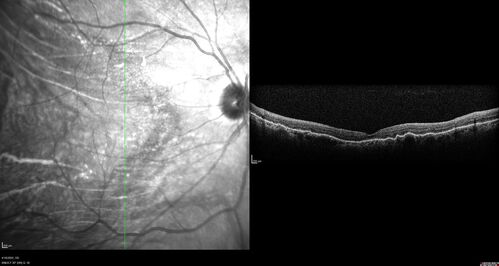 Choroidal Hemorrhage following intraocular lens exchange surgery
68 year old man Patient is 1 week post IOL exchange with sutured Akreos PCIOL with PST Kenalog.  IOP was 12 on POD 1 and 21 today (POD 7).  Preop the IOP was 17.  
He has a history of retinal detachment repair 12 years ago with PPV, Buckle, Laser and Gas.

VA OD: 20/200, OS: 20/50.  IOP 21, 19
