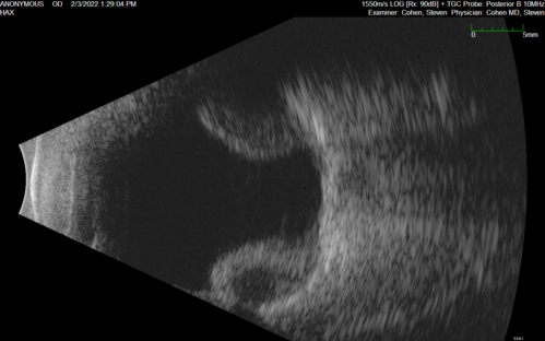 Choroidal Effusions following IOL exchange
67 year old man 10 years ago had retinal detachment with buckle, vitrectomy, laser, gas.  Vision was 20/25 post-op.  2 months ago had sudden vision loss in the right eye from a dislocated PCIOL (in the bag).  3 weeks ago had a vitrectomy, remove IOL and scleral suture fixation of Akreos AO60 PCIOL with gortex sutures.  IOP was 12 on post-op day 1 with a vitreous hemorrhage.  Post-op day 7, vitreous hemorrhage cleared.
PMhx: HTN, High Cholesterol.
Med: Amlodipine, ASA, Atorvastatin, Metoprolol
Vision 20/200,
