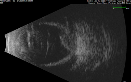 Choroidal Effusions following IOL exchange
67 year old man 10 years ago had retinal detachment with buckle, vitrectomy, laser, gas.  Vision was 20/25 post-op.  2 months ago had sudden vision loss in the right eye from a dislocated PCIOL (in the bag).  3 weeks ago had a vitrectomy, remove IOL and scleral suture fixation of Akreos AO60 PCIOL with gortex sutures.  IOP was 12 on post-op day 1 with a vitreous hemorrhage.  Post-op day 7, vitreous hemorrhage cleared.
PMhx: HTN, High Cholesterol.
Med: Amlodipine, ASA, Atorvastatin, Metoprolol
Vision 20/200,
