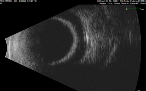 Choroidal Effusions following IOL exchange
67 year old man 10 years ago had retinal detachment with buckle, vitrectomy, laser, gas.  Vision was 20/25 post-op.  2 months ago had sudden vision loss in the right eye from a dislocated PCIOL (in the bag).  3 weeks ago had a vitrectomy, remove IOL and scleral suture fixation of Akreos AO60 PCIOL with gortex sutures.  IOP was 12 on post-op day 1 with a vitreous hemorrhage.  Post-op day 7, vitreous hemorrhage cleared.
PMhx: HTN, High Cholesterol.
Med: Amlodipine, ASA, Atorvastatin, Metoprolol
Vision 20/200,
