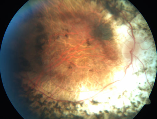 Enhanced S Cone Syndrome - Goldmann Favre - NR2E3 Mutation
82 year old man with poor vision for many years.  VA HM OD, 5/200 OS. Diagnosed at age 12 with retinitis pigmentosa. Nystagmus.
