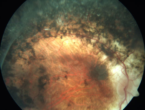 Enhanced S Cone Syndrome - Goldmann Favre - NR2E3 Mutation
82 year old man with poor vision for many years.  VA HM OD, 5/200 OS. Diagnosed at age 12 with retinitis pigmentosa. Nystagmus.
