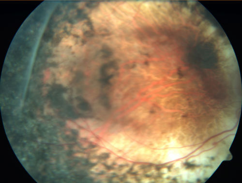 Enhanced S Cone Syndrome - Goldmann Favre - NR2E3 Mutation
82 year old man with poor vision for many years.  VA HM OD, 5/200 OS. Diagnosed at age 12 with retinitis pigmentosa. Nystagmus.
