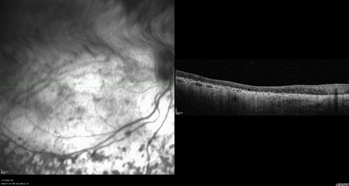 Enhanced S Cone Syndrome - Goldmann Favre - NR2E3 Mutation
82 year old man with poor vision for many years.  VA HM OD, 5/200 OS. Diagnosed at age 12 with retinitis pigmentosa. Nystagmus.
