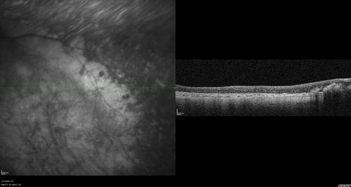 Enhanced S Cone Syndrome - Goldmann Favre - NR2E3 Mutation
82 year old man with poor vision for many years.  VA HM OD, 5/200 OS. Diagnosed at age 12 with retinitis pigmentosa. Nystagmus.
