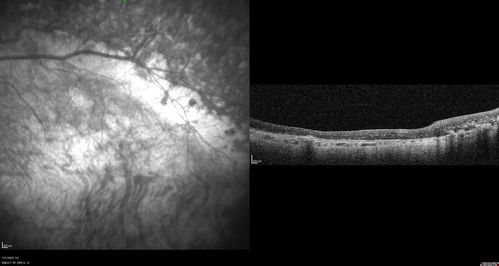 Enhanced S Cone Syndrome - Goldmann Favre - NR2E3 Mutation
82 year old man with poor vision for many years.  VA HM OD, 5/200 OS. Diagnosed at age 12 with retinitis pigmentosa. Nystagmus.
