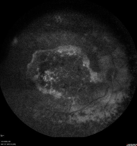 Enhanced S Cone Syndrome - Goldmann Favre - NR2E3 Mutation
82 year old man with poor vision for many years.  VA HM OD, 5/200 OS. Diagnosed at age 12 with retinitis pigmentosa. Nystagmus.
