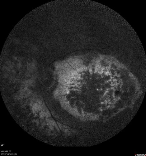 Enhanced S Cone Syndrome - Goldmann Favre - NR2E3 Mutation
82 year old man with poor vision for many years.  VA HM OD, 5/200 OS. Diagnosed at age 12 with retinitis pigmentosa. Nystagmus.
