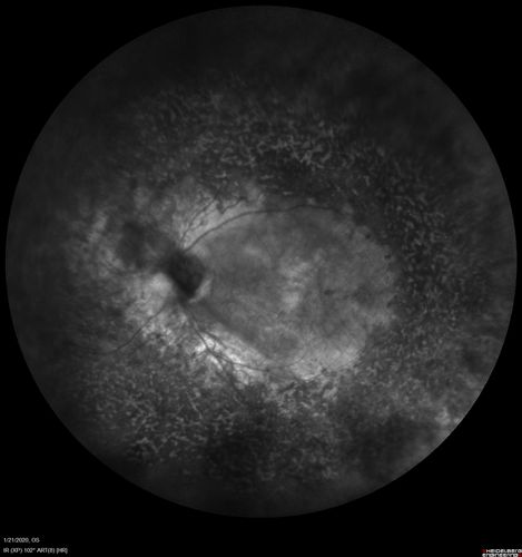 Enhanced S Cone Syndrome - Goldmann Favre - NR2E3 Mutation
82 year old man with poor vision for many years.  VA HM OD, 5/200 OS. Diagnosed at age 12 with retinitis pigmentosa. Nystagmus.
