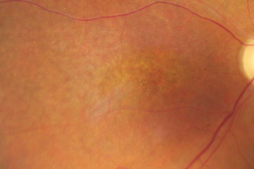Fundus Photograph  - Enhanced S Cone Syndrome - Goldmann Favre - 
55-year-old woman  while in college her vision was poor even with glasses and she sought evaluation for that.  She was told after she had an electroretinogram at USF 15 years ago, that she had something with her blue cones.  She does have poor night vision, but her reading vision is pretty good. 

VISUAL ACUITY:  OD 20/40,  OS 20/40

