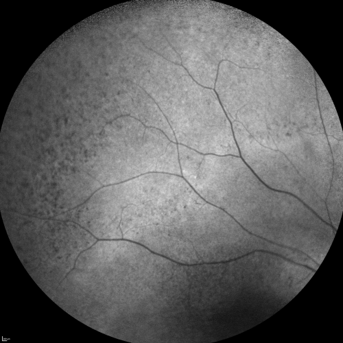 Fundus Autofluorescence  - Enhanced S Cone Syndrome - Goldmann Favre - 
55-year-old woman  while in college her vision was poor even with glasses and she sought evaluation for that.  She was told after she had an electroretinogram at USF 15 years ago, that she had something with her blue cones.  She does have poor night vision, but her reading vision is pretty good. 

VISUAL ACUITY:  OD 20/40,  OS 20/40
