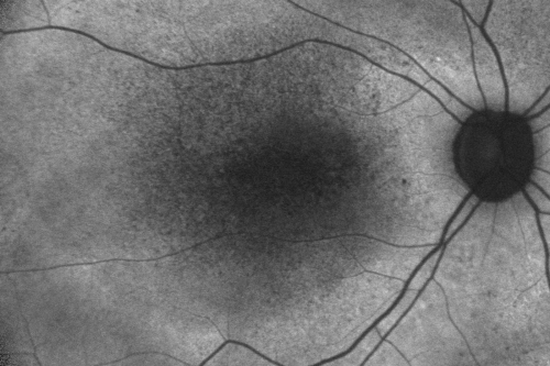 Fundus Autofluorescence  - Enhanced S Cone Syndrome - Goldmann Favre - 
55-year-old woman  while in college her vision was poor even with glasses and she sought evaluation for that.  She was told after she had an electroretinogram at USF 15 years ago, that she had something with her blue cones.  She does have poor night vision, but her reading vision is pretty good. 

VISUAL ACUITY:  OD 20/40,  OS 20/40
