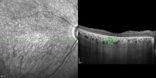 OCT Line Scan  - Enhanced S Cone Syndrome - Goldmann Favre - 
55-year-old woman  while in college her vision was poor even with glasses and she sought evaluation for that.  She was told after she had an electroretinogram at USF 15 years ago, that she had something with her blue cones.  She does have poor night vision, but her reading vision is pretty good. 

VISUAL ACUITY:  OD 20/40,  OS 20/40
