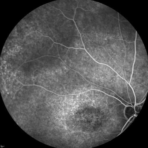 Fluorescein Angiogram  - Enhanced S Cone Syndrome - Goldmann Favre - 
55-year-old woman  while in college her vision was poor even with glasses and she sought evaluation for that.  She was told after she had an electroretinogram at USF 15 years ago, that she had something with her blue cones.  She does have poor night vision, but her reading vision is pretty good. 

VISUAL ACUITY:  OD 20/40,  OS 20/40
