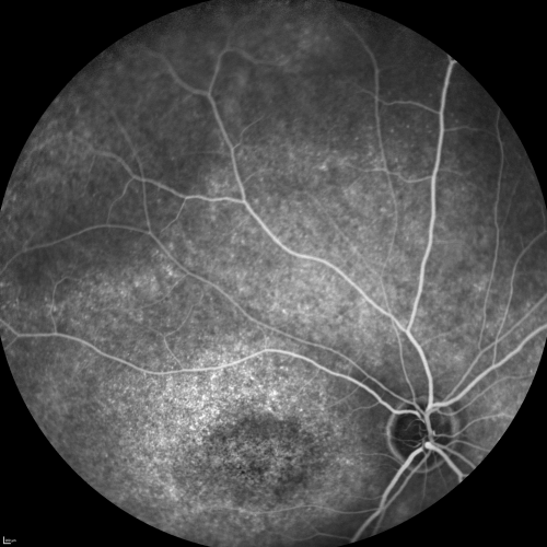 Fluorescein Angiogram  - Enhanced S Cone Syndrome - Goldmann Favre - 
55-year-old woman  while in college her vision was poor even with glasses and she sought evaluation for that.  She was told after she had an electroretinogram at USF 15 years ago, that she had something with her blue cones.  She does have poor night vision, but her reading vision is pretty good. 

VISUAL ACUITY:  OD 20/40,  OS 20/40
