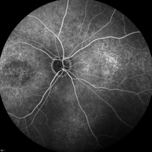 Fluorescein Angiogram  - Enhanced S Cone Syndrome - Goldmann Favre - 
55-year-old woman  while in college her vision was poor even with glasses and she sought evaluation for that.  She was told after she had an electroretinogram at USF 15 years ago, that she had something with her blue cones.  She does have poor night vision, but her reading vision is pretty good. 

VISUAL ACUITY:  OD 20/40,  OS 20/40
