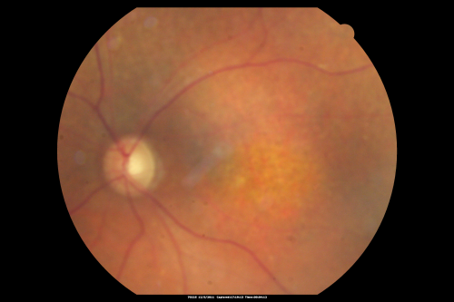 Fundus Photograph  - Enhanced S Cone Syndrome - Goldmann Favre - 
55-year-old woman  while in college her vision was poor even with glasses and she sought evaluation for that.  She was told after she had an electroretinogram at USF 15 years ago, that she had something with her blue cones.  She does have poor night vision, but her reading vision is pretty good. 

VISUAL ACUITY:  OD 20/40,  OS 20/40
