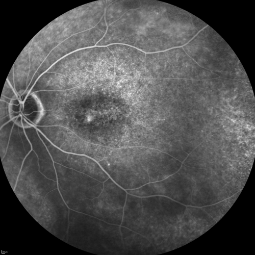 Fluorescein Angiogram  - Enhanced S Cone Syndrome - Goldmann Favre - 
55-year-old woman  while in college her vision was poor even with glasses and she sought evaluation for that.  She was told after she had an electroretinogram at USF 15 years ago, that she had something with her blue cones.  She does have poor night vision, but her reading vision is pretty good. 

VISUAL ACUITY:  OD 20/40,  OS 20/40
