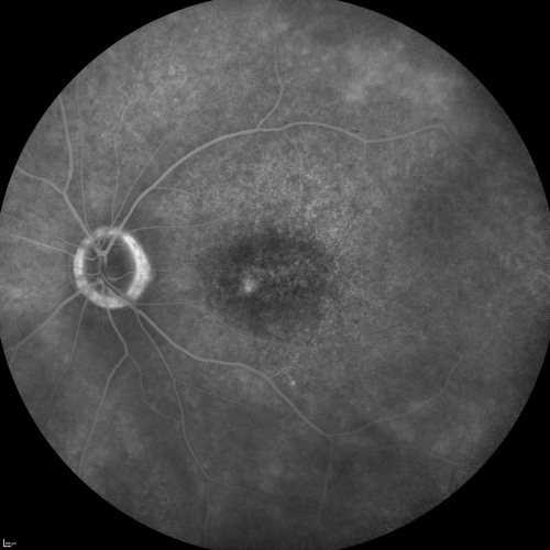 Fluorescein Angiogram  - Enhanced S Cone Syndrome - Goldmann Favre - 
55-year-old woman  while in college her vision was poor even with glasses and she sought evaluation for that.  She was told after she had an electroretinogram at USF 15 years ago, that she had something with her blue cones.  She does have poor night vision, but her reading vision is pretty good. 

VISUAL ACUITY:  OD 20/40,  OS 20/40
