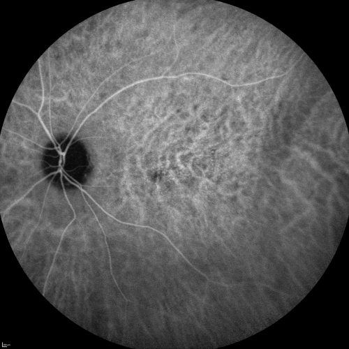Indocyanine Green Angiogram  - Enhanced S Cone Syndrome - Goldmann Favre - 
55-year-old woman  while in college her vision was poor even with glasses and she sought evaluation for that.  She was told after she had an electroretinogram at USF 15 years ago, that she had something with her blue cones.  She does have poor night vision, but her reading vision is pretty good. 

VISUAL ACUITY:  OD 20/40,  OS 20/40
