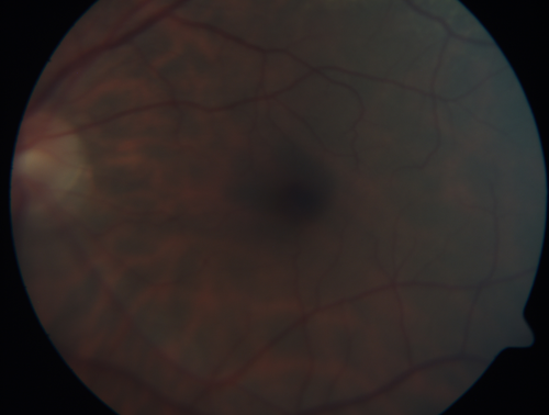 Equatorial Drusen
61 year old female with normal visoin
