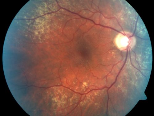 Equatorial Drusen
76-year-old man with equatorial drusen

VISUAL ACUITY:  Vision OD is 20/40, OS is 20/25. 

