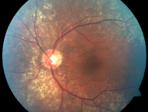 Equatorial Drusen
76-year-old man with equatorial drusen

VISUAL ACUITY:  Vision OD is 20/40, OS is 20/25. 
