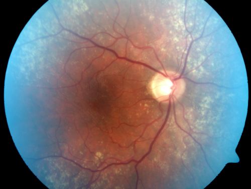 Equatorial Drusen
76-year-old man with equatorial drusen

VISUAL ACUITY:  Vision OD is 20/40, OS is 20/25. 
