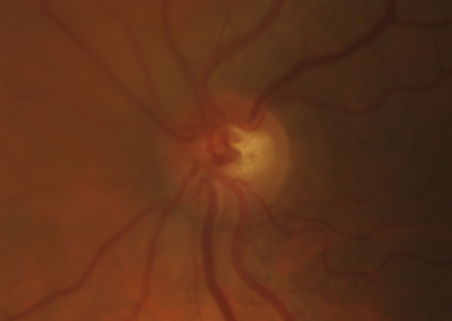 Toxic Optic Neuropathy - Ethambutol
15 months of Ethambutol with rapid vision loss OU.  VA 20/100 OD (post cataract sugery ) 20/200 OS with dense cataract.  There is temporal RNFL loss in both eyes
