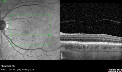 Choroidal Excavation left eye
63 year old vision with right eye vision loss at age 27 possibly from histoplasmosis.  Left eye has a choroidal excavation
