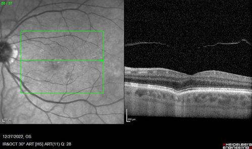 Choroidal Excavation left eye
63 year old vision with right eye vision loss at age 27 possibly from histoplasmosis.  Left eye has a choroidal excavation
