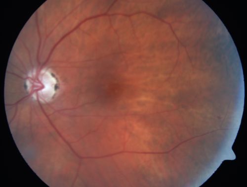 Eccentric Disciform Scar - Breakthrough Vitreous Hemorrhage - InferoTemporal Subretinal Fibrosis - Ectopic Choroidal Neovascular Membranes
88-year-old man has noticed for the last few months the vision in the right eye is foggy, like there is a film in the eye or a haze,  His vision is 20/16 in each eye. 
Right eye - inferotemporal periphery there is a hemorrhage at the equator at about 7:00 oâ€™clock, which is about 4-disc diameters across and adjacent to that there is scarring.
Left eye - large disciform scar inferotemporally
