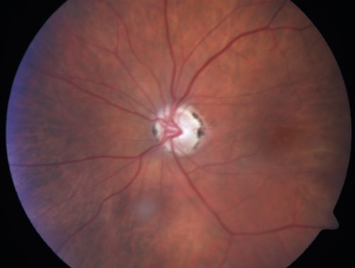 Eccentric Disciform Scar - Breakthrough Vitreous Hemorrhage - InferoTemporal Subretinal Fibrosis - Ectopic Choroidal Neovascular Membranes
88-year-old man has noticed for the last few months the vision in the right eye is foggy, like there is a film in the eye or a haze,  His vision is 20/16 in each eye. 
Right eye - inferotemporal periphery there is a hemorrhage at the equator at about 7:00 oâ€™clock, which is about 4-disc diameters across and adjacent to that there is scarring.
Left eye - large disciform scar inferotemporally
