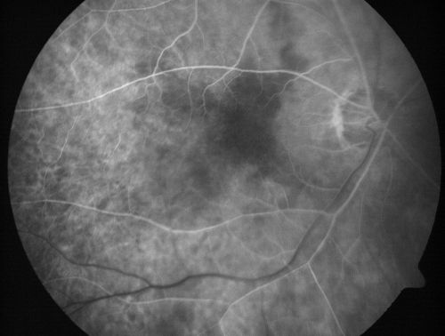 Eccentric Disciform Scar - Breakthrough Vitreous Hemorrhage - InferoTemporal Subretinal Fibrosis - Ectopic Choroidal Neovascular Membranes
88-year-old man has noticed for the last few months the vision in the right eye is foggy, like there is a film in the eye or a haze,  His vision is 20/16 in each eye. 
Right eye - inferotemporal periphery there is a hemorrhage at the equator at about 7:00 oâ€™clock, which is about 4-disc diameters across and adjacent to that there is scarring.
Left eye - large disciform scar inferotemporally
