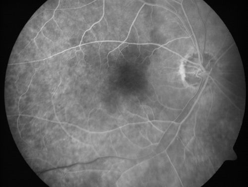 Eccentric Disciform Scar - Breakthrough Vitreous Hemorrhage - InferoTemporal Subretinal Fibrosis - Ectopic Choroidal Neovascular Membranes
88-year-old man has noticed for the last few months the vision in the right eye is foggy, like there is a film in the eye or a haze,  His vision is 20/16 in each eye. 
Right eye - inferotemporal periphery there is a hemorrhage at the equator at about 7:00 oâ€™clock, which is about 4-disc diameters across and adjacent to that there is scarring.
Left eye - large disciform scar inferotemporally
